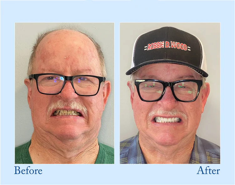 HEATWOLF® - Premium Customized Full Denture Set🦷-💎💎The Royal London Dental Hospital accreditation(🏆Limited Time Discount Last 30 Minutes🏆)