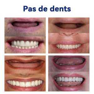 HEATWOLF® 🦷 Prothèse Dentaire Complète Sur Mesure Haut de Gamme 💎 (⏰Promotion limitée - Plus que 30 minutes !)