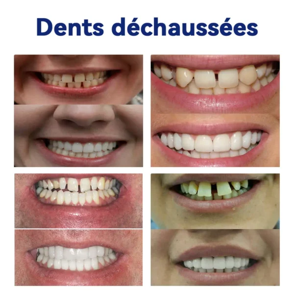 HEATWOLF® 🦷 Prothèse Dentaire Complète Sur Mesure Haut de Gamme 💎 (⏰Promotion limitée - Plus que 30 minutes !)