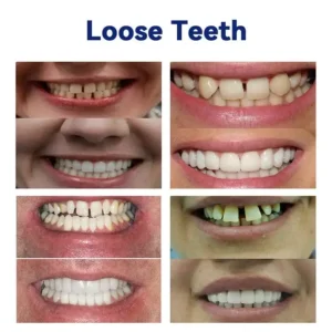 HEATWOLF™-🦷Advanced Customized Full Denture Set🦷 -👨‍⚕️Mayo Clinic Certification🔥(Limited Time Discount Last 30 Minutes)🎁🎁