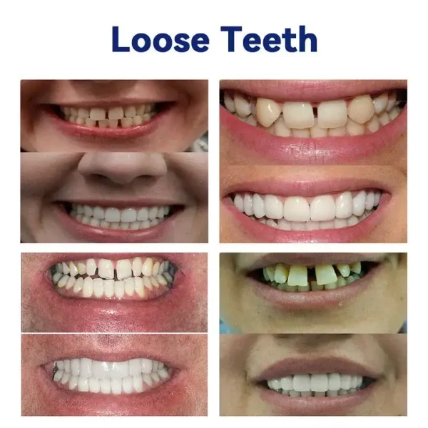 HEATWOLF™-🦷Advanced Customized Full Denture Set🦷 -👨‍⚕️Mayo Clinic Certification🔥(Limited Time Discount Last 30 Minutes)🎁🎁