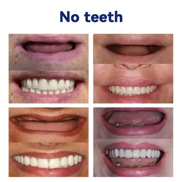 HEATWOLF® 🧡Premium Advanced Customized Full Denture Set 🧡 (⏰Limited time discount last 30 minutes)