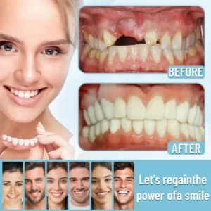 HEATWOLF® - Premium Customized Full Denture Set🦷-🏆🏆The Royal London Dental Hospital accreditation(🏆Limited Time Discount Last 30 Minutes🏆)