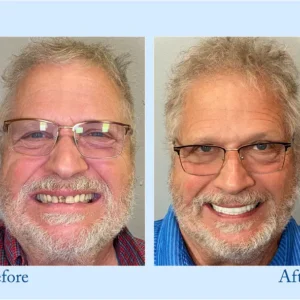 HEATWOLF® - Premium Customized Full Denture Set🦷-🏆🏆The Royal London Dental Hospital accreditation(🏆Limited Time Discount Last 30 Minutes🏆)