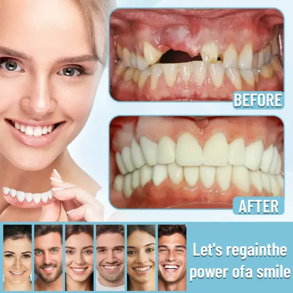 HEATWOLF® - Premium Customized Full Denture Set🦷-🥇🥇The Royal London Dental Hospital accreditation(🏆Limited Time Discount Last 30 Minutes🏆)