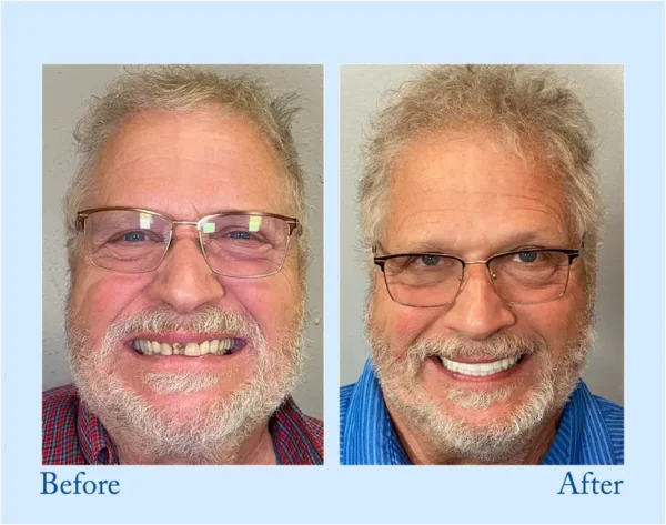 HEATWOLF® - Premium Customized Full Denture Set🦷-🥇🥇The Royal London Dental Hospital accreditation(🏆Limited Time Discount Last 30 Minutes🏆)