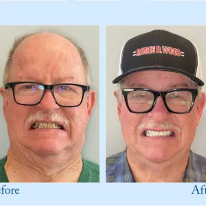 HEATWOLF® - Premium Customized Full Denture Set🦷-🥇🥇The Royal London Dental Hospital accreditation(🏆Limited Time Discount Last 30 Minutes🏆)