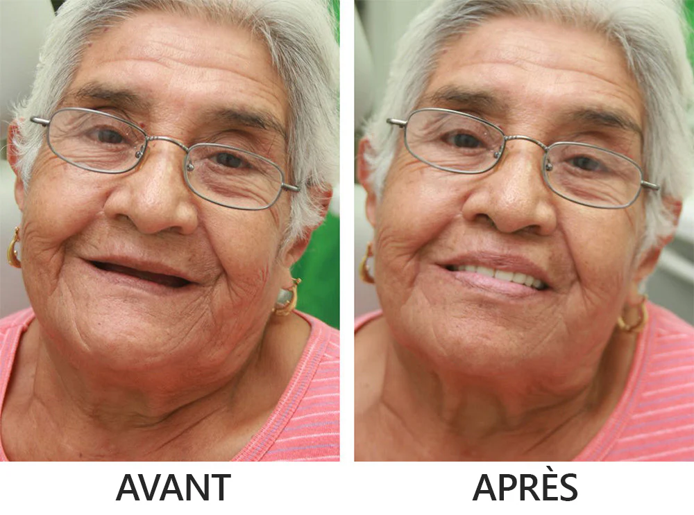 Boutique Officielle | 🌟Ensemble Complet de Dentiers en Silicone HEATWOLF® 🧑🏼‍⚕️Recommandé par l’Association Dentaire Française (ADF)