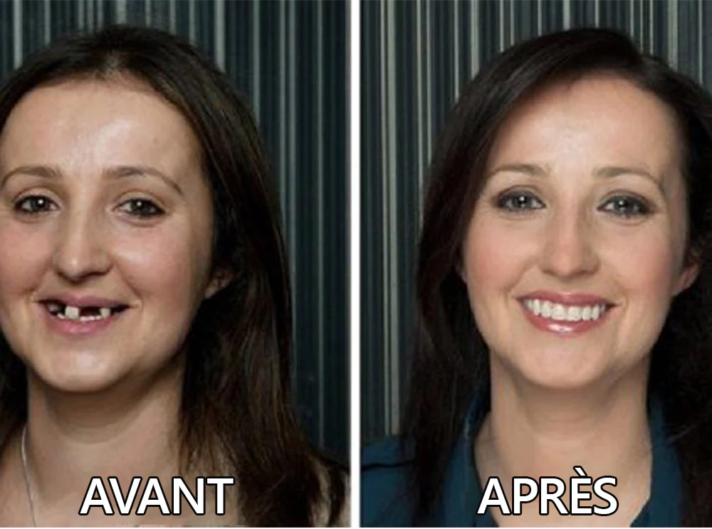Boutique Officielle | 🌟Ensemble Complet de Dentiers en Silicone HEATWOLF® 🧑🏼‍⚕️Recommandé par l’Association Dentaire Française (ADF)