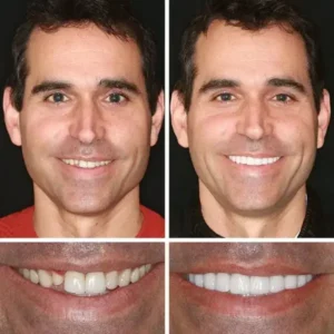 (Affordable Beauty🧏‍♀️🧏‍♂️)–Laozik™ –Advanced Customized Full Denture Set🦷