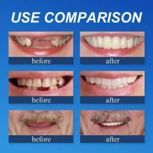 (Affordable Beauty🧏‍♀️🧏‍♂️)–Laozik™ –Advanced Customized Full Denture Set🦷
