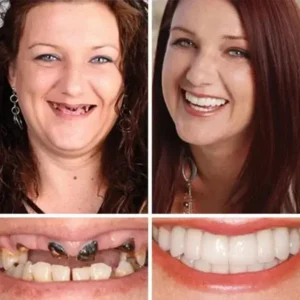 (Affordable Beauty🧏‍♀️🧏‍♂️)–Laozik™ –Advanced Customized Full Denture Set🦷