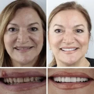 (Affordable Beauty🧏‍♀️🧏‍♂️)–Laozik™ –Advanced Customized Full Denture Set🦷