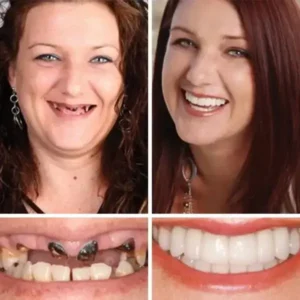 (Affordable Beauty🧏‍♀️🧏‍♂️)–NESLEMY™ –Advanced Customized Full Denture Set🦷