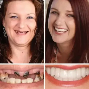 Clinclii™ –Advanced Customized Full Denture Set🦷
