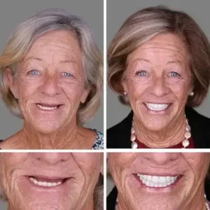 Clinclii™ –Advanced Customized Full Denture Set🦷
