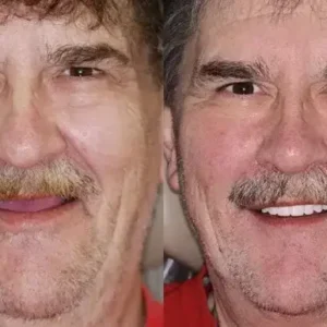 {Developed by Harvard University}🦷Advanced Customized Full Denture Set🦷