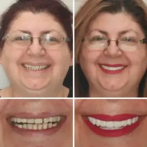 Hidone® Fuldt tandproteser Sæt 🦷🦷💃Avancerede selvjusterende tandlæge Materialer (⏰Begrænset tidsrabat sidste 30 minutter⏰)