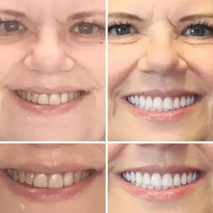 Hidone® Fuldt tandproteser Sæt 🦷🦷💃Avancerede selvjusterende tandlæge Materialer (⏰Begrænset tidsrabat sidste 30 minutter⏰)