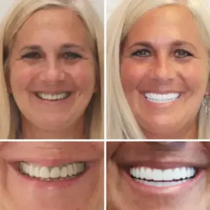Hidone® Fuldt tandproteser Sæt 🦷🦷💃Avancerede selvjusterende tandlæge Materialer (⏰Begrænset tidsrabat sidste 30 minutter⏰)