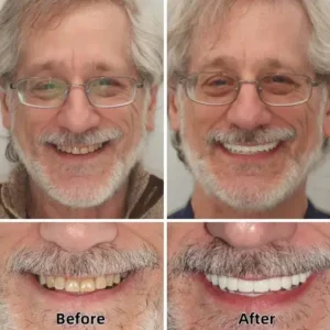 Laozik™-Advanced Custom-Fit Functional Dentures