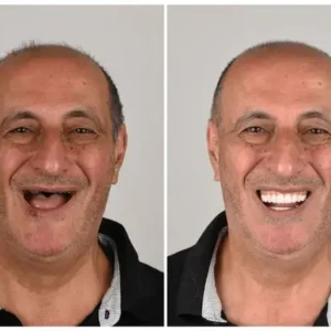 🦷 Denturelix™ Custom-Fit Functional Dentures 😁 Smile with Confidence