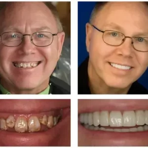 🦷 Denturelix™ Custom-Fit Functional Dentures 😁 Smile with Confidence