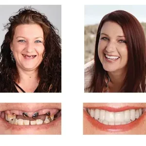 🦷 Denturelix™ Custom-Fit Functional Dentures 😁 Smile with Confidence