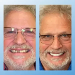 😁 “Snap In. Stay Put. Smile All Day — Or Your Money Back!” 𝗠𝗲𝗱𝗶𝗰𝗮𝗹-𝗚𝗿𝗮𝗱𝗲 𝗙𝘂𝗻𝗰𝘁𝗶𝗼𝗻𝗮𝗹 𝗧𝗵𝗶𝗰𝗸𝗲𝗻𝗲𝗱 𝗗𝗲𝗻𝘁𝘂𝗿𝗲𝘀