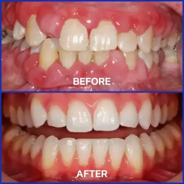 🇬🇧👨🏼⚕️Rolimey® VioGloss Bee Venom Dental Therapy Oral Power🦷