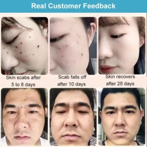 HZA™ Concentrated potent skin tag removal cream