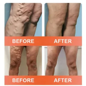 Seurico™ Vein Ease Microneedle Care Patch