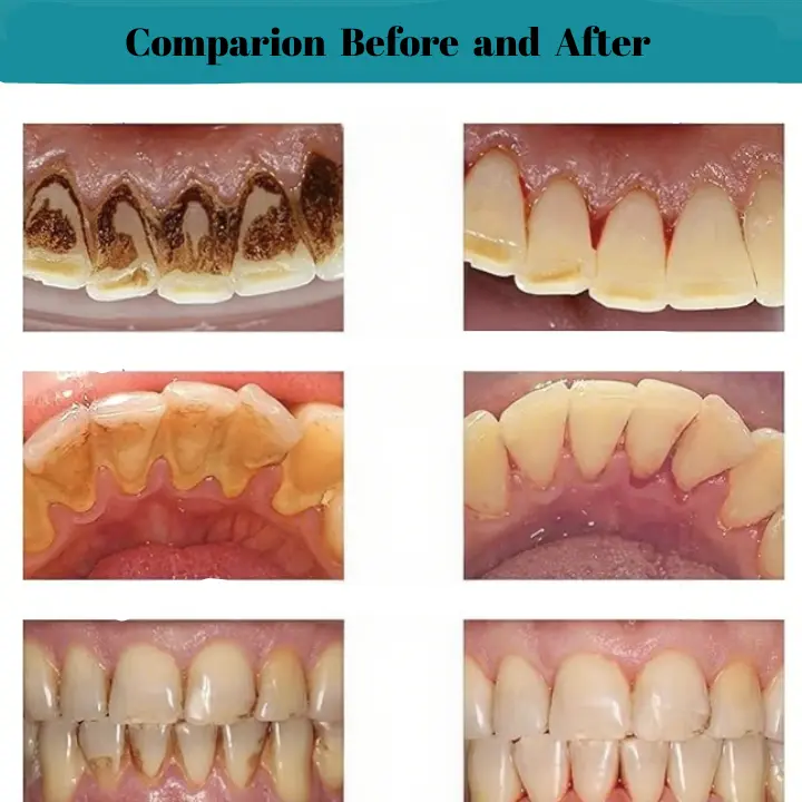 AEXZR® Oral Calculus Suppressant